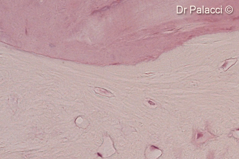 Một phần mẫu sinh thiết được lấy 4 tháng sau khi tăng cường bằng GTO. Các hạt vật liệu sinh học được bao quanh bởi xương mới hình thành, có sự hiện diện của các hốc tế bào xương