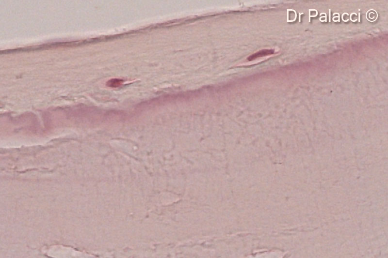 Một phần mẫu sinh thiết được lấy 4 tháng sau khi tăng cường bằng GTO. Các hạt vật liệu sinh học được bao quanh bởi xương mới hình thành, có sự hiện diện của các hốc tế bào xương