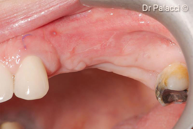 1 tuần sau phẫu thuật. Quan sát quá trình lành lại của mô mềm