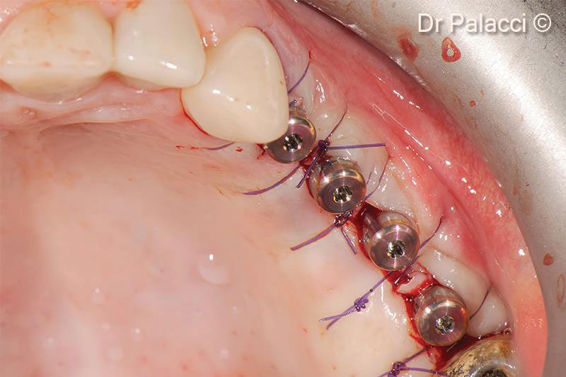 Thao tác mô mềm xung quanh cấy ghép