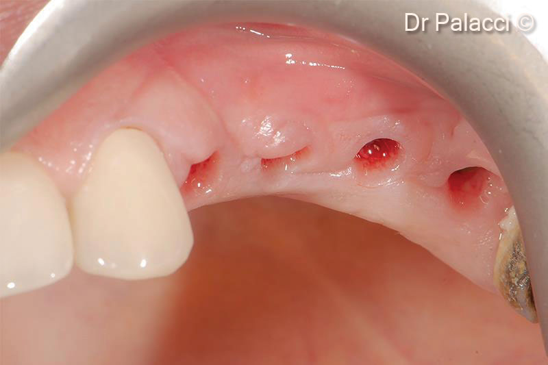 Quá trình lành thương sau 3 tuần. Lưu ý sự nâng cao sống hàm cũng như hình dạng, màu sắc và kết cấu của mô mềm