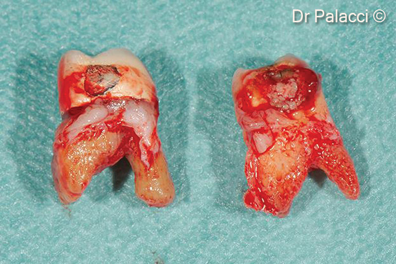 Răng bị nhổ, toàn bộ xương môi bị mất có thể thấy rõ sự tiêu xương nghiêm trọng
