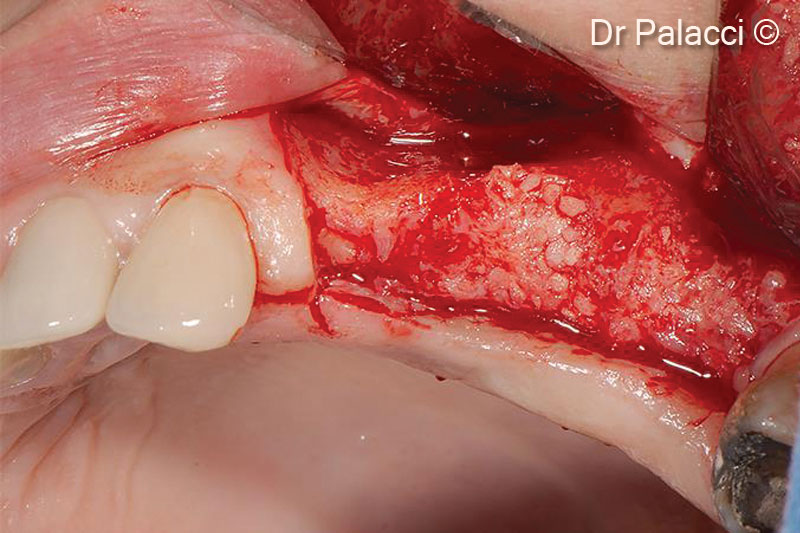 4 implant đường kính 3.5mm được cấy ghép