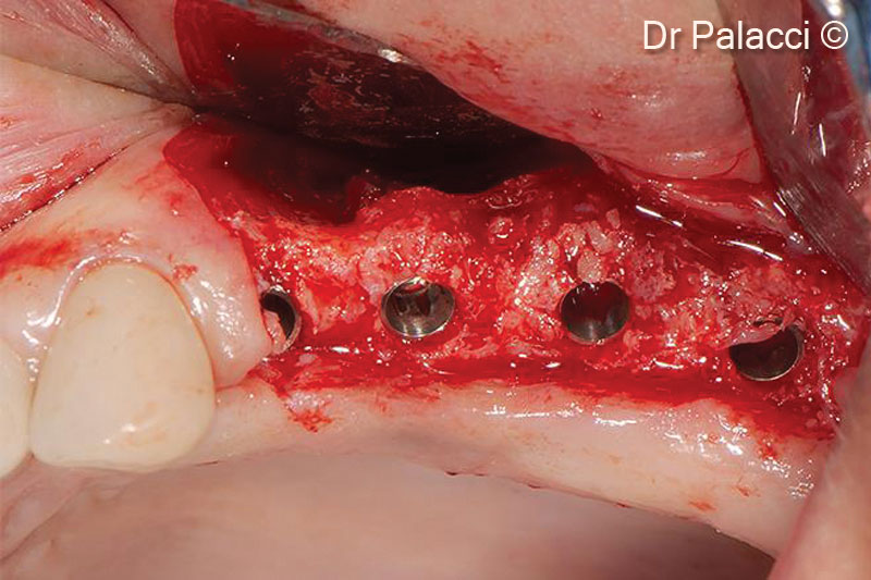 Một màng collagen bao phủ vùng khuyết tật được lấp đầy bằng vật liệu sinh học