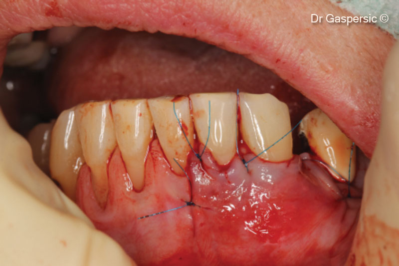 Khâu vết thương