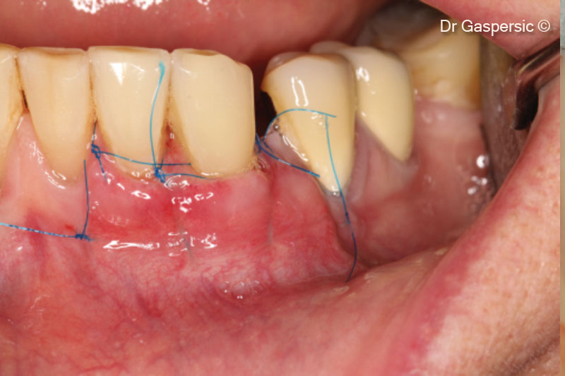 Quá trình phục hồi sau 1 tuần