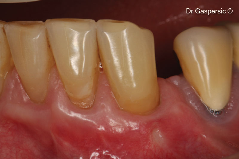 Theo dõi trong 2 năm