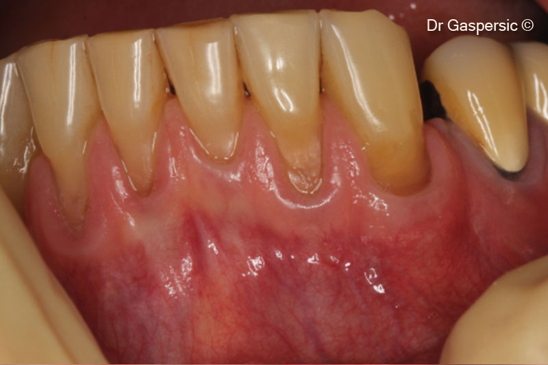 Các khuyết tật do suy thoái và sói mòn