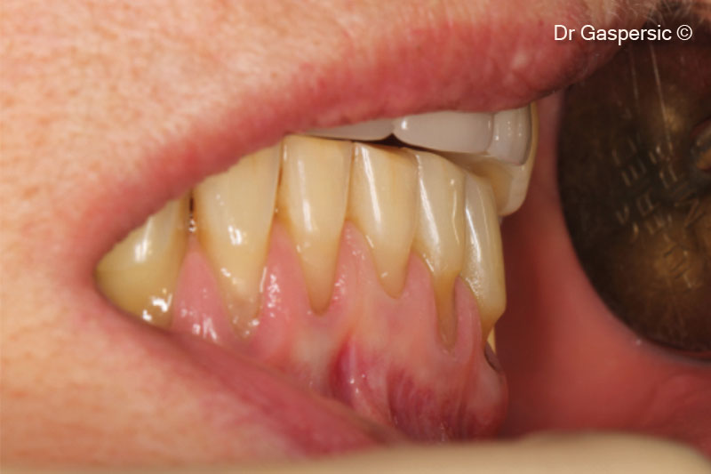 Các khuyết tật do suy thoái và sói mòn