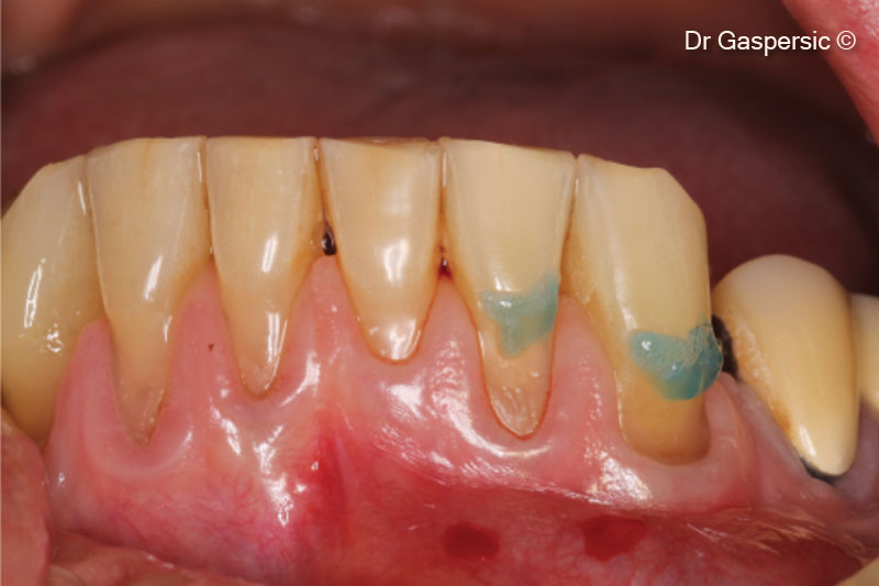 Khắc men răng trước khi phục hồi các khuyết tật men răng