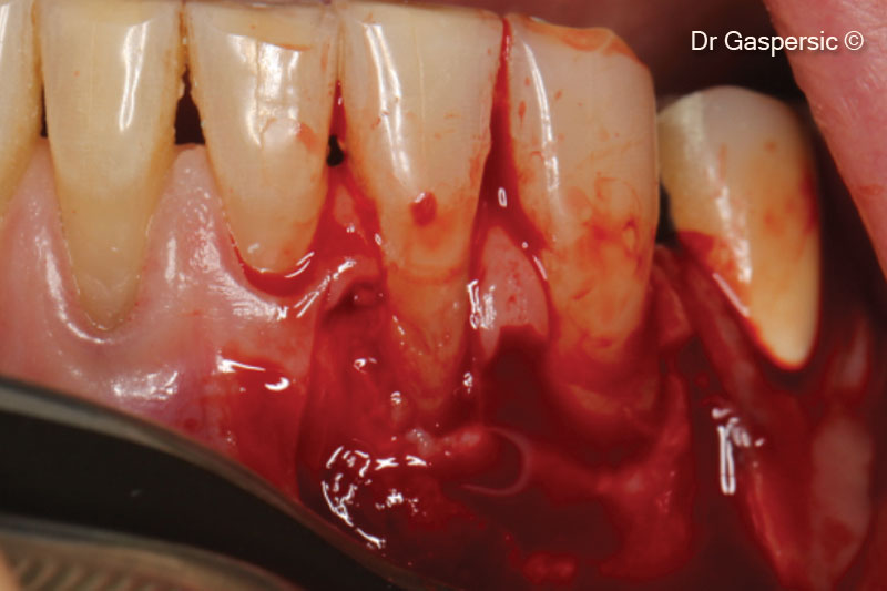 Nâng vạt da có độ dày chia đôi