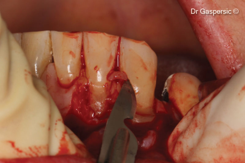 Loại bỏ các nhú