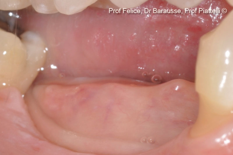 Hình ảnh lâm sàng trước phẫu thuật của một trường hợp teo xương hàm dưới bên phải phía sau.