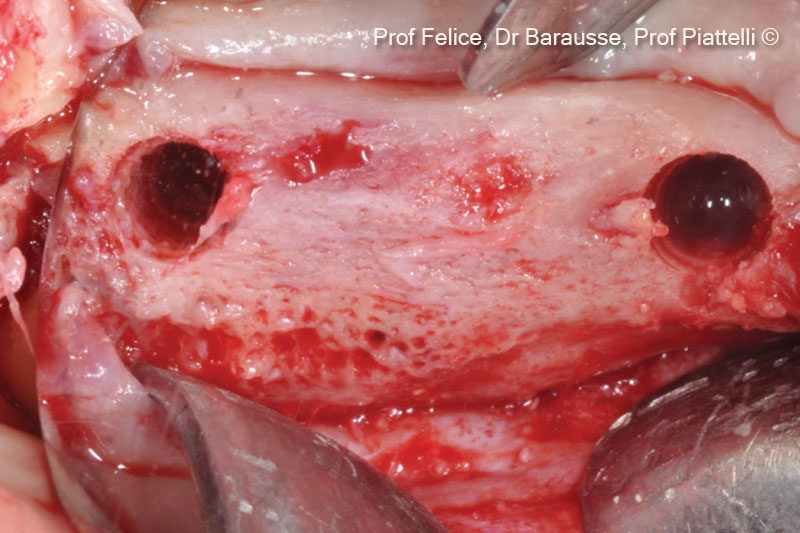 Chuẩn bị đường hầm cấy ghép trong xương tái tạo