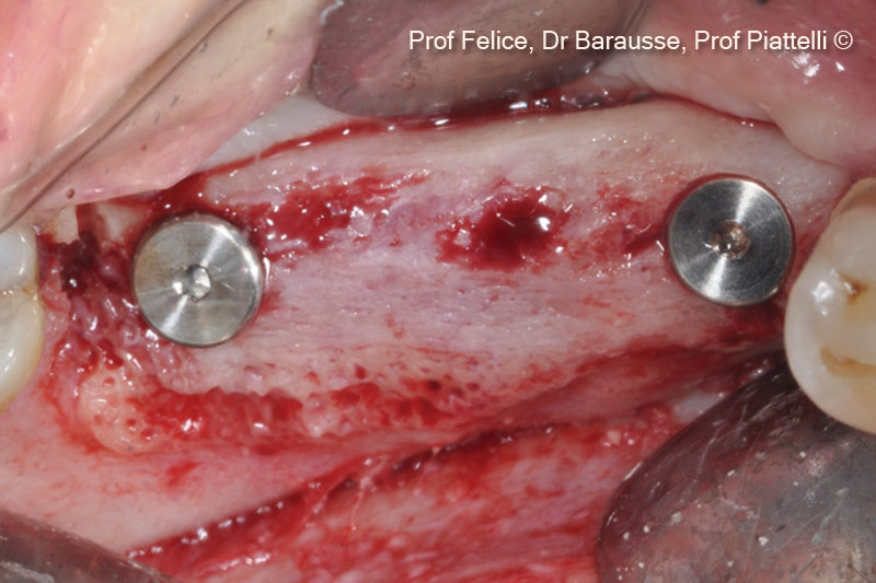 Hai thiết bị cấy ghép được đặt vào trong cuộc phẫu thuật tái thông.