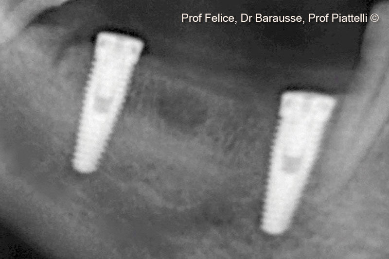 Chụp X-quang sau khi định vị cấy ghép