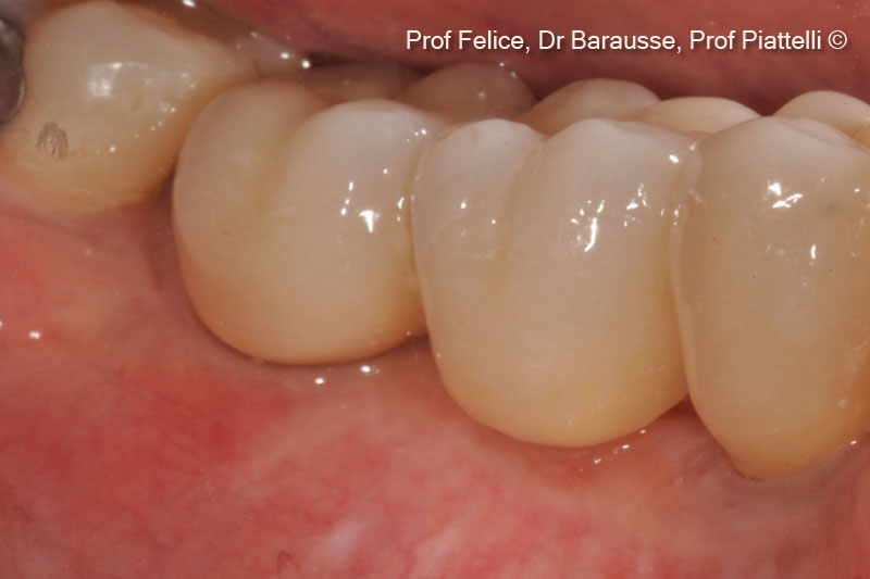 Hình ảnh lâm sàng của bộ phận giả cố định sau một năm.