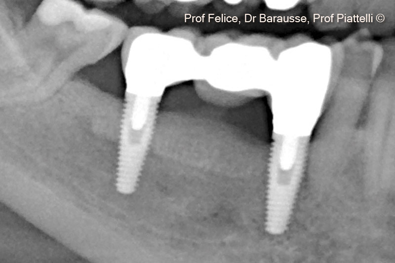 Hình ảnh chụp X-quang với răng giả cố định sau 5 năm.