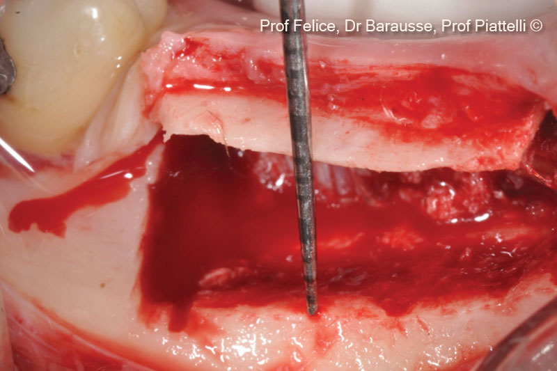 Đoạn xương đã được cắt rời được nâng lên theo hướng vành