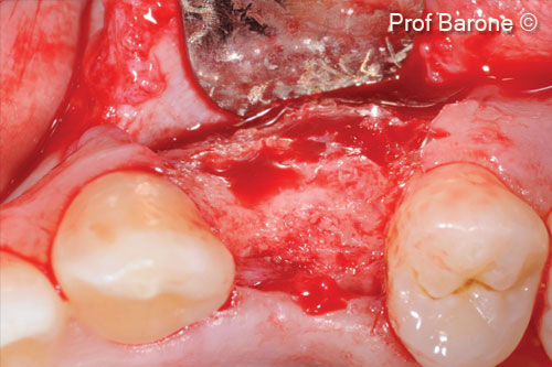 Quá trình tái tạo xương diễn ra sáu tháng sau thủ thuật nâng xương hàm. Một số hạt còn sót lại vẫn có thể nhìn thấy, các hạt vật liệu sinh học đã được tích hợp tốt vào xương mới và có nhiều mạch máu.