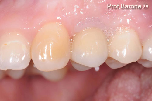 Phục hồi cuối cùng