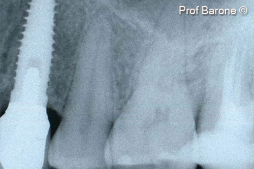 Phục hồi cuối cùng