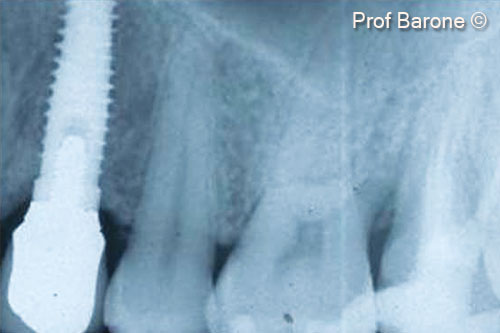Theo dõi trong bảy năm