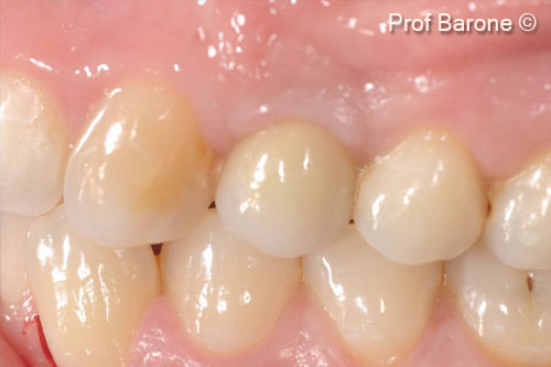 Theo dõi trong mười ba năm