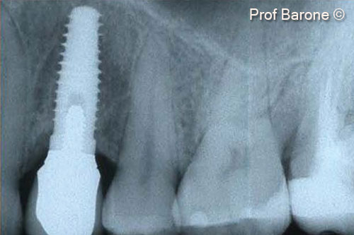 Theo dõi trong mười ba năm