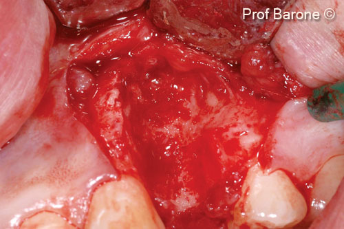 Hình ảnh trong quá trình phẫu thuật. Một vạt mô dày toàn bộ được nâng lên, răng được nhổ bỏ và xuất hiện một khuyết tật xương nghiêm trọng.