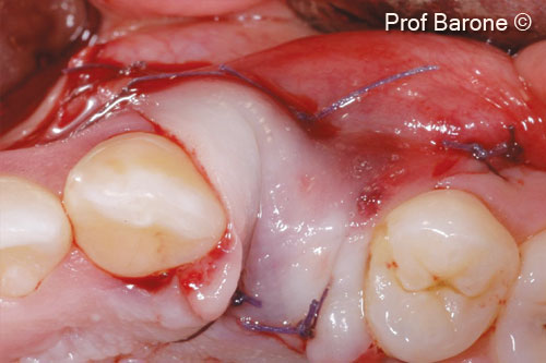 Khâu kín mô mềm ban đầu được thực hiện