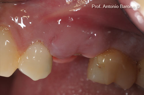 Hình ảnh lâm sàng mặt ngoài miệng cho thấy quá trình lành thương sau 10 ngày