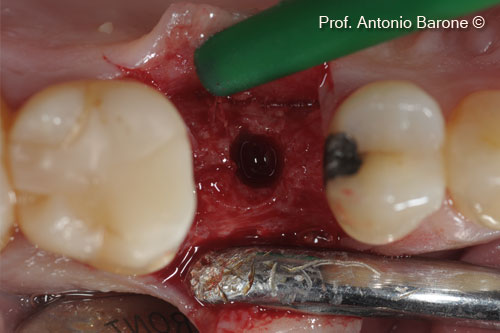 Hình ảnh lâm sàng của sống hàm sau 5 tháng lành thương.  Mẫu sinh thiết xương đã được lấy