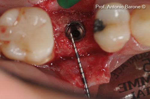 Hình ảnh lâm sàng của implant đã được cấy ghép.  Đo độ dày xương mặt ngoài