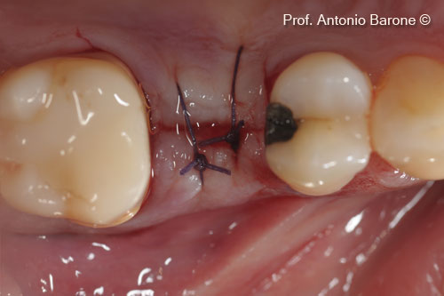 Hình ảnh lâm sàn của các đường khâu
