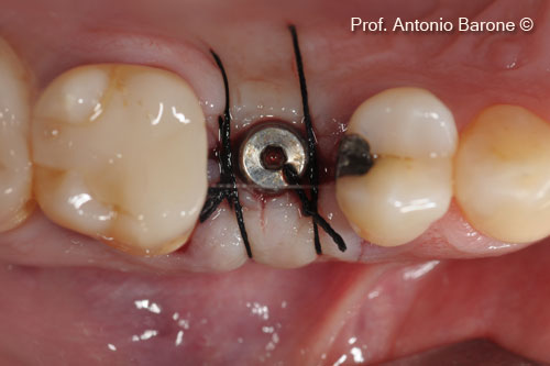 Hình ảnh lâm sàn mặt nhai sau khi bộc lộ implant