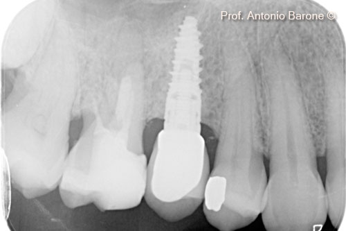 Hình ảnh X-Quang chóp răng 1 năm  sau khi cấy ghép implant