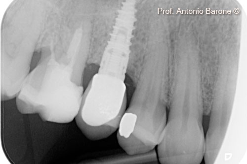 Hình ảnh X-Quang chóp răng 3 năm  sau khi cấy ghép implant