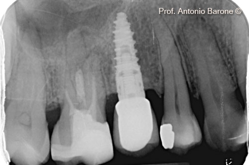 Hình ảnh X-Quang chóp răng 7 năm  sau khi cấy ghép implant
