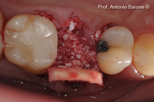 Hình ảnh lâm sàng mặt nhai của mảnh ghép xương ổ răng với chất nền mp3 và derma