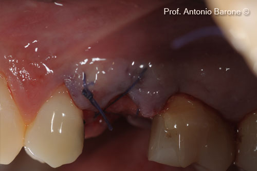 Hình ảnh lâm sàng nhìn từ phía má của miếng ghép Derma được gấp về phía vòm miệng và cố định bằng các mũi khâu tự tiêu