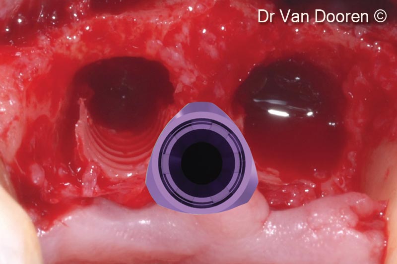 Hình ảnh nhìn từ mặt nhai sau khi tháo implant: sống hàm đã được chỉnh sửa và làm phẳng bằng phẫu thuật sau khi tháo implant. Implant sẽ được đặt ở vị trí phía vòm miệng hơn và "ở giữa" so với các hố nhổ răng để đạt được độ ổn định ban đầu tuyệt vời cho việc tải trọng tức thì.