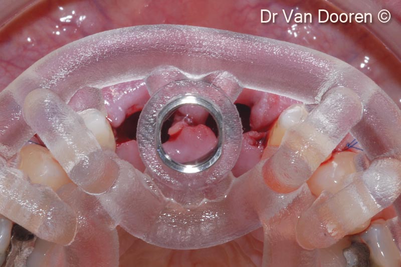 Đặt implant (V3/ RP 3,9 mm - 13 mm) bằng dụng cụ dẫn hướng MGuide (MIS). Vị trí vòm miệng để có được phục hình cố định bằng vít là điểm mấu chốt trong trường hợp cụ thể này