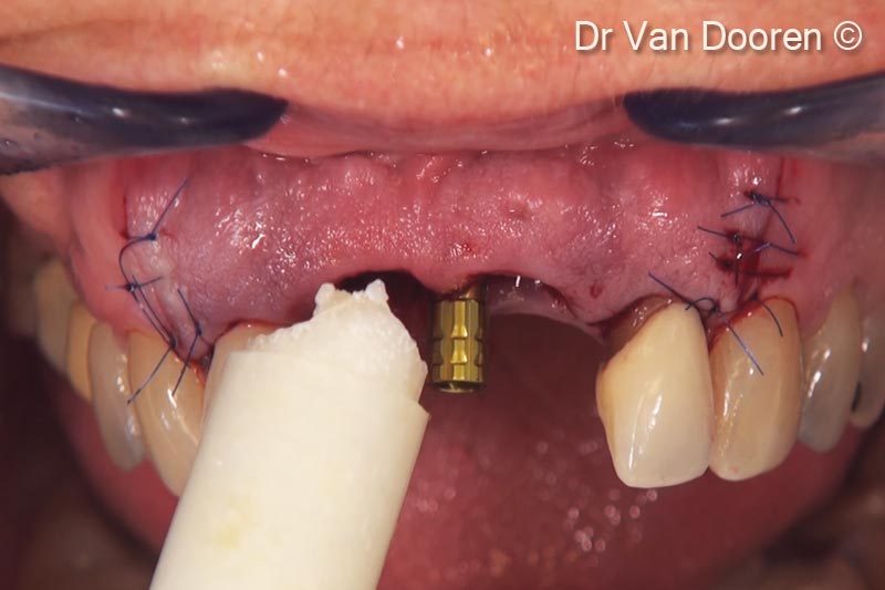 Sau khi đặt trụ tạm thời, OsteoBiol® GTO® được đặt và chèn đầy bằng dụng cụ và xung quanh implant để hỗ trợ mô mềm.