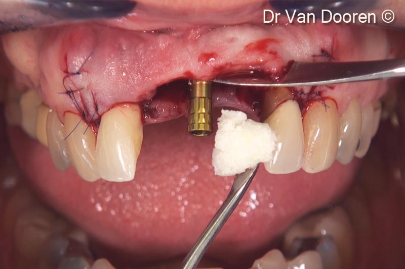 Sau khi đặt trụ tạm thời, OsteoBiol® GTO® được đặt và chèn đầy bằng dụng cụ và xung quanh implant để hỗ trợ mô mềm.