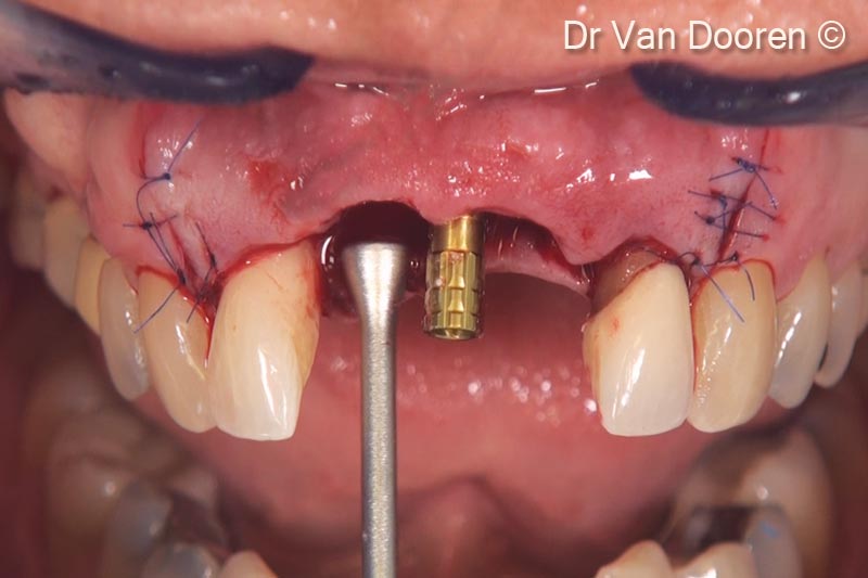 Sau khi đặt trụ tạm thời, OsteoBiol® GTO® được đặt và chèn đầy bằng dụng cụ và xung quanh implant để hỗ trợ mô mềm.