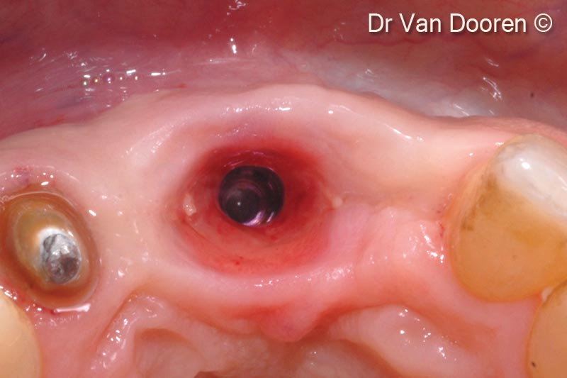 Sau khi hoàn tất việc chuẩn bị răng số 22, dấu răng kỹ thuật số được lấy bằng máy quét ScanPost (MIS).
