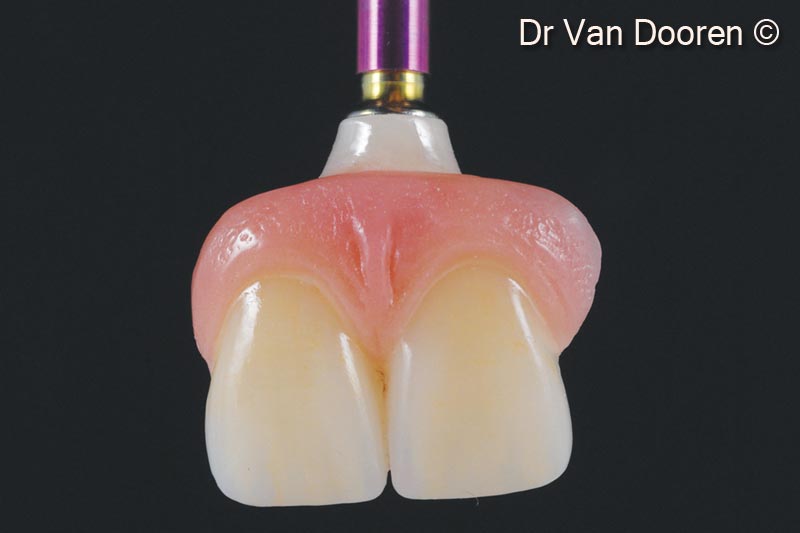 Một cầu răng zirconia cố định bằng vít gồm 2 đơn vị (#11 và #21) và một mão răng đơn (răng #22) đã được mài và xếp lớp.