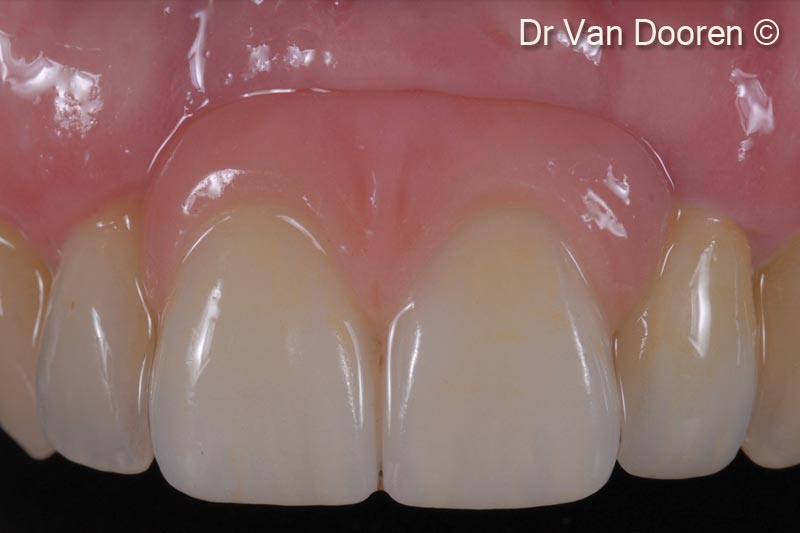 Final clinical result. Note the integration and gingival health