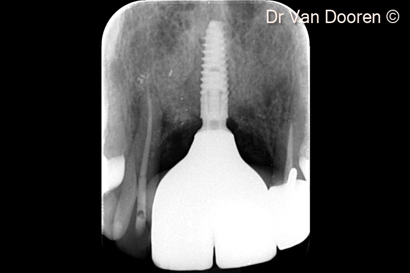 Ảnh chụp X-quang cuối cùng. Lưu ý mức độ xương viền ổn định xung quanh implant và sự tích hợp tốt của vật liệu ghép (OsteoBiol® GTO®) trong khoang quanh implant.